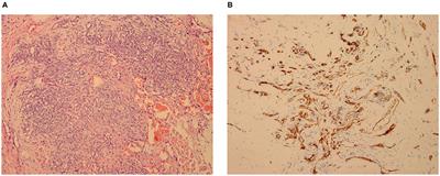 Case Report: Kaposiform Hemangioendothelioma With Spinal Involvement